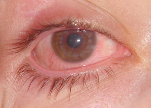 sunburned-eye
