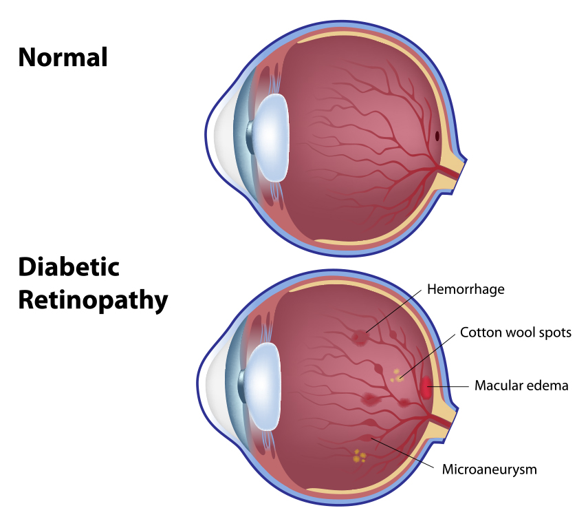 diabetic-retinopathy